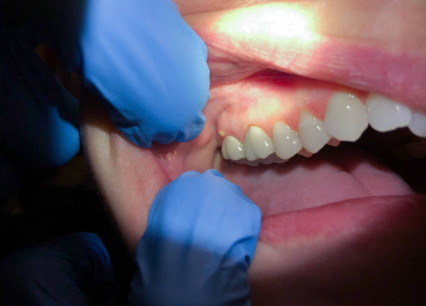 Best Emergency Dental Extractions in Broad Creek, NC