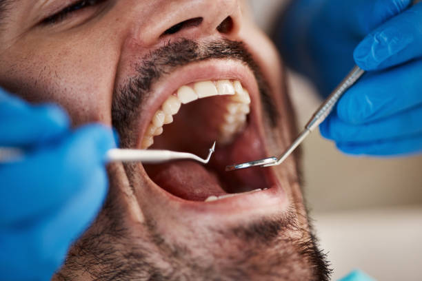 Best Emergency Dentist for Lost Fillings or Crowns in Broad Creek, NC